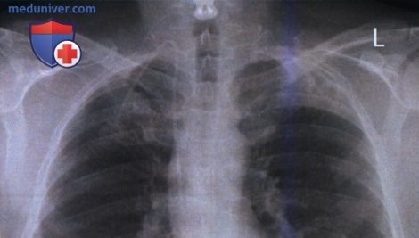 Примеры анализа качества рентгенограмм органов грудной клетки в аксиальной (лордотической) передне-задней (ПЗ) проекции