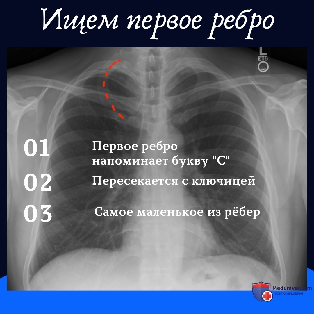 Как считать ребра на рентгенограмме грудной клетки