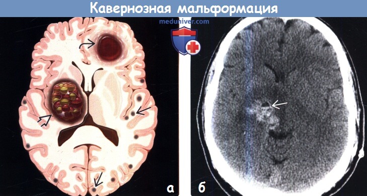 Кавернозная мальформация головного мозга на КТ