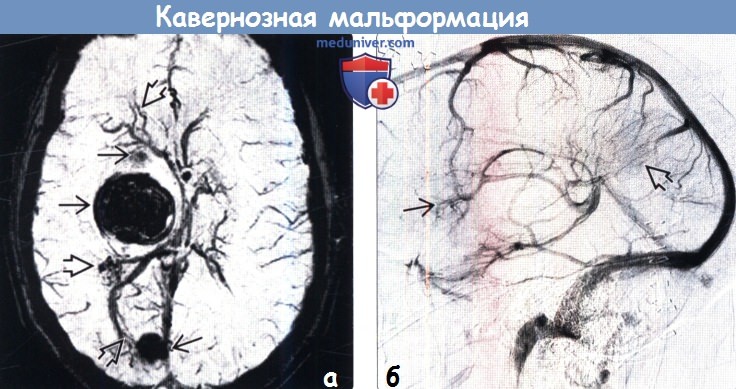 Кавернозная мальформация головного мозга на МРТ, ангиограмме