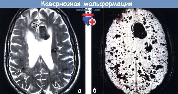 Кавернозная мальформация головного мозга на МРТ