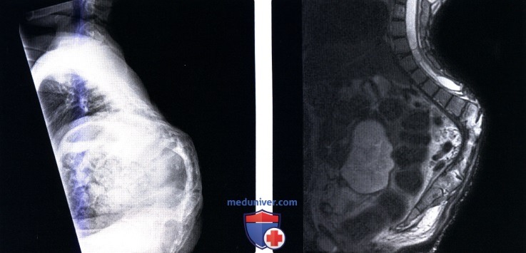 Рентгенограмма, МРТ позвоночника при кифозе