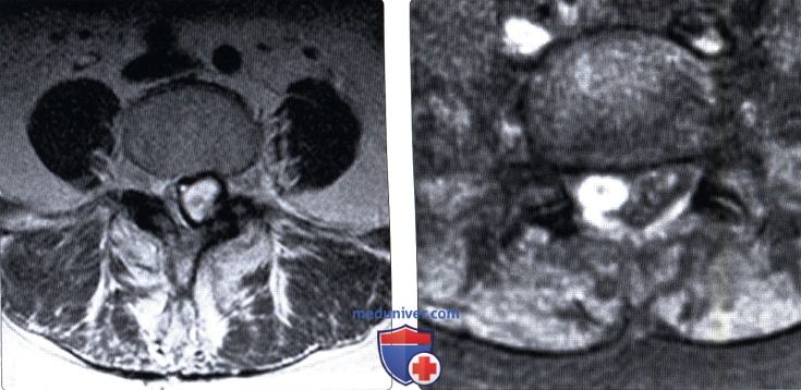 МРТ синовиальной кисты дугоотростчатого сустава позвоночника