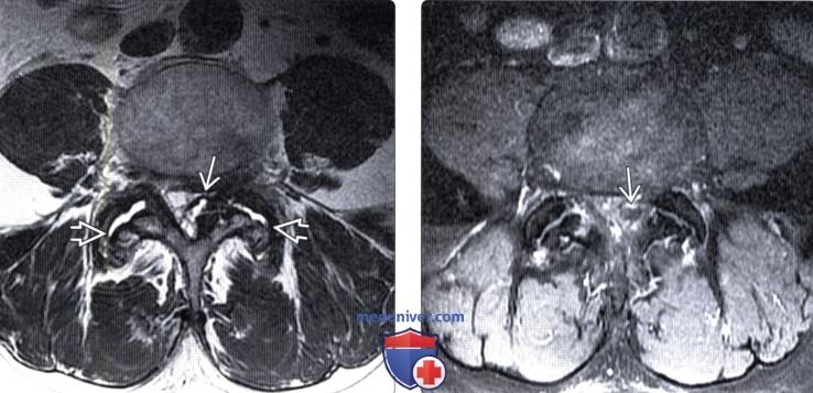 КТ, МРТ синовиальной кисты дугоотростчатого сустава позвоночника