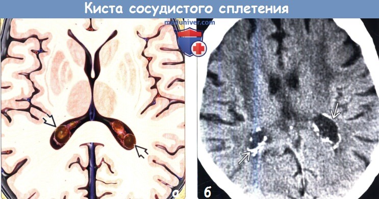 Киста сосудистого сплетения головного мозга на КТ