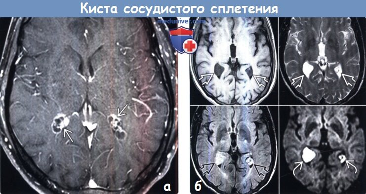 Сосудистые сплетения головного мозга плода. Кисты боковых желудочков мозга мрт. Ксантогранулема сосудистого сплетения мрт. НСГ киста сосудистого сплетения 3 мм. Эпендимальная киста головного мозга.