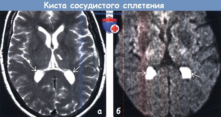 Киста сосудистого сплетения головного мозга на МРТ