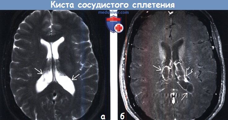 Киста сосудистого сплетения головного мозга на МРТ