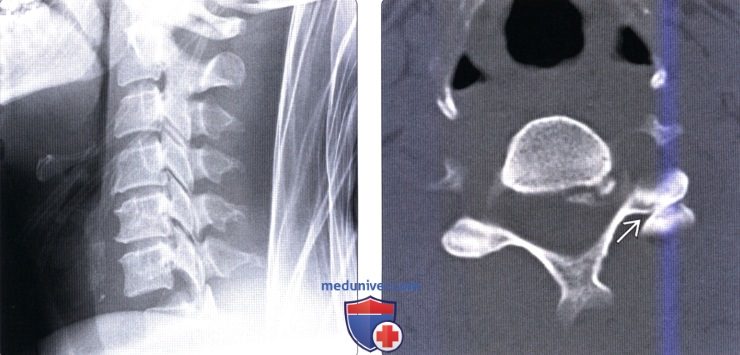 Рентгенограмма, КТ переломов шейных позвонков