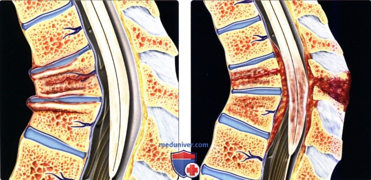Переломы грудных и поясничных позвонков
