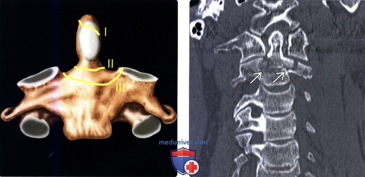 Классификация переломов шейного отдела thumbnail