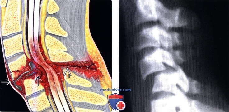 Рентгенограмма переломов шейных позвонков