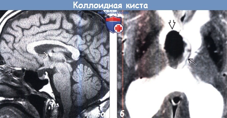 Коллоидная киста головного мозга на МРТ