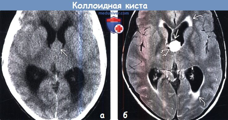 Коллоидная киста головного мозга на КТ, МРТ