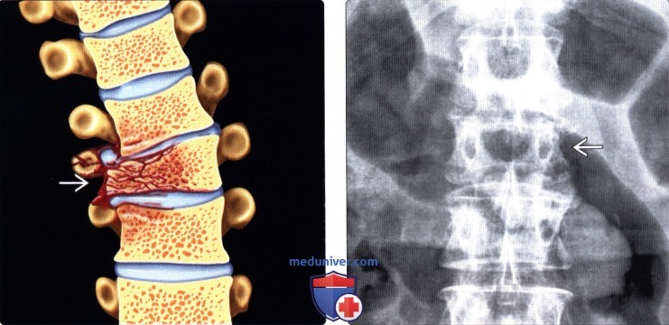 Рентгенограмма при компрессионном переломе позвонка с латеральной компрессией