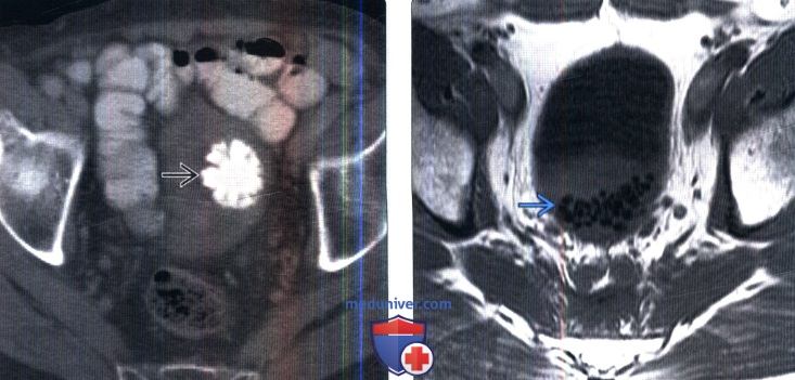 Рентгенограмма, КТ, МРТ при конкрементах мочевого пузыря