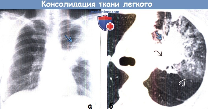 Консолидация легочной ткани на рентгенограмме и КТ