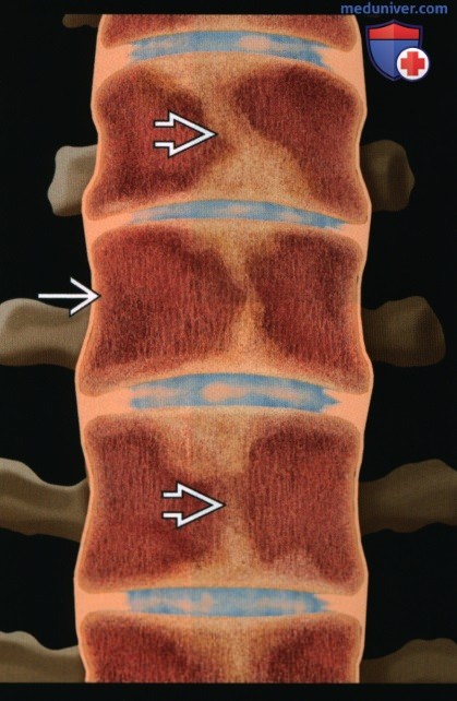 Кости при миелофиброзе - лучевая диагностика