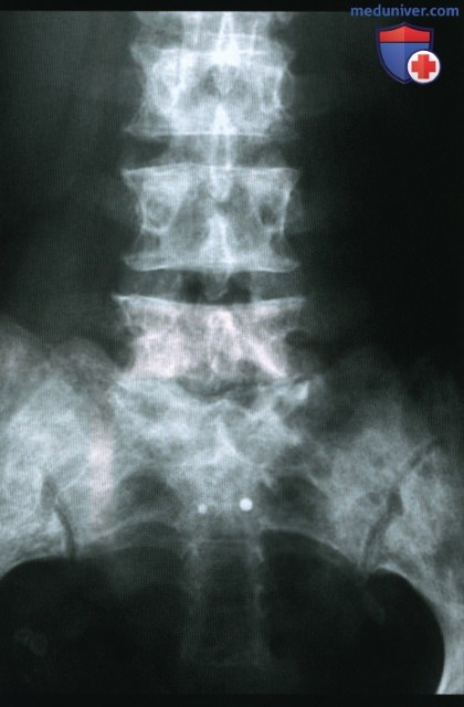 Кости при миелофиброзе - лучевая диагностика
