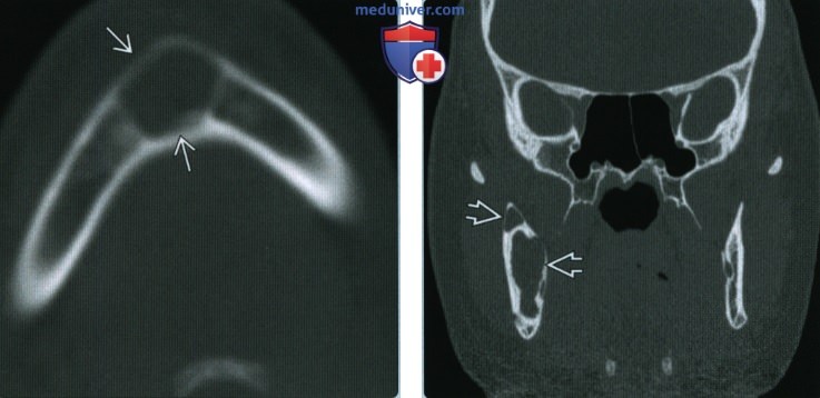 Простая костная киста (травматическая) челюсти - лучевая диагностика
