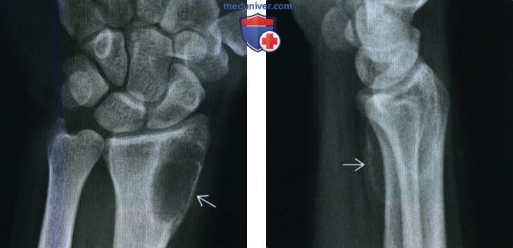 Аневризмальная костная киста - лучевая диагностика