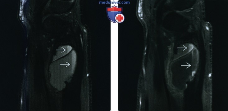 Аневризмальная костная киста - лучевая диагностика