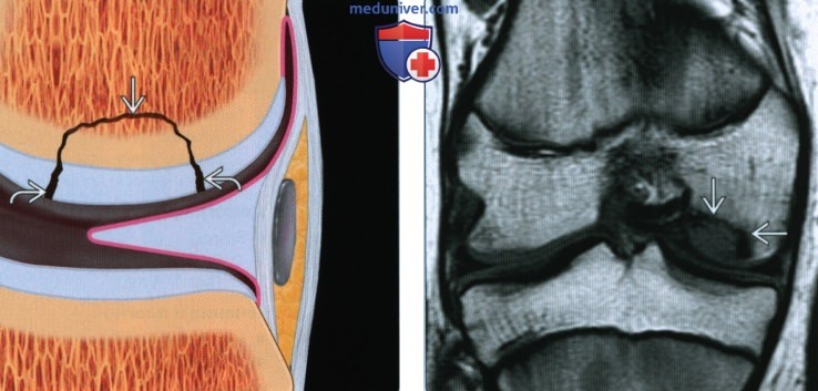 Признаки костно-хрящевой травмы коленного сустава