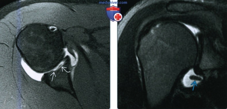 Признаки костно-хрящевого повреждения плечевого сустава