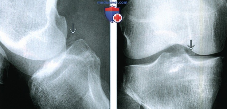 Признаки косточки мениска коленного сустава