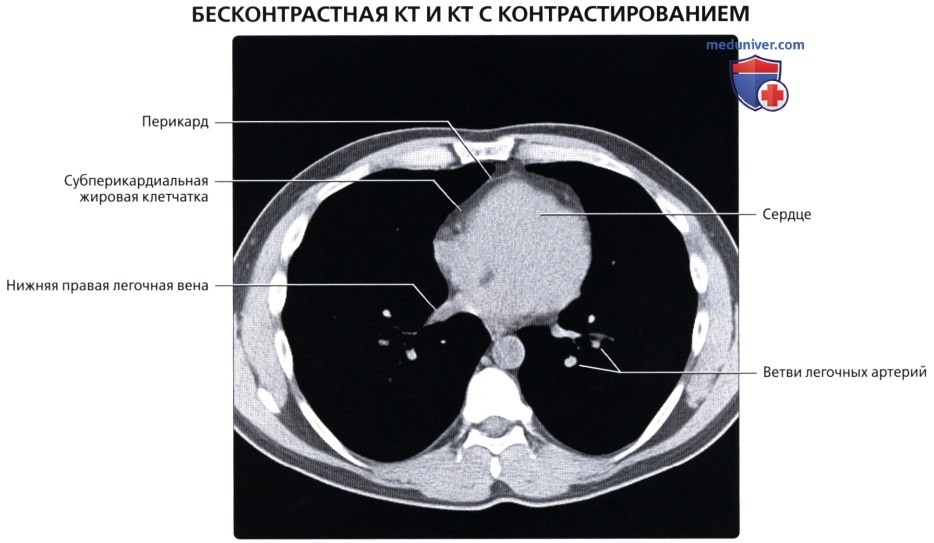 КТ анатомия грудной клетки в норме