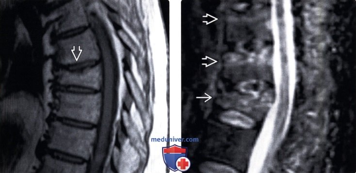 МРТ при компрессионном переломе позвонка с передней компрессией