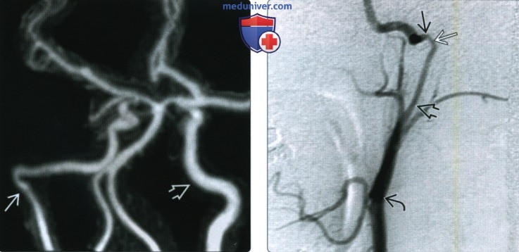 КТ, МРТ, ангиография при аберрантной внутренней сонной артерии (АбВСА)