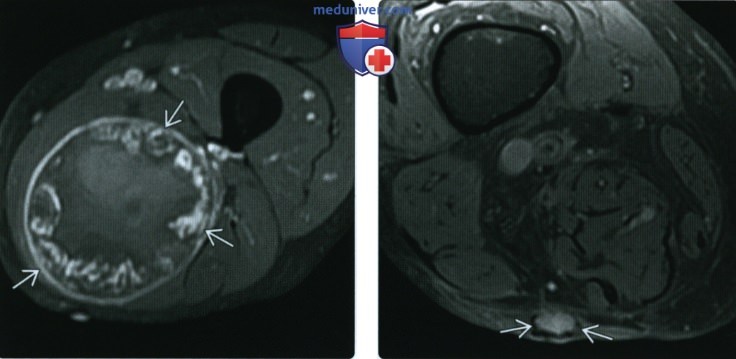 КТ, МРТ при ангиосаркоме мягких тканей