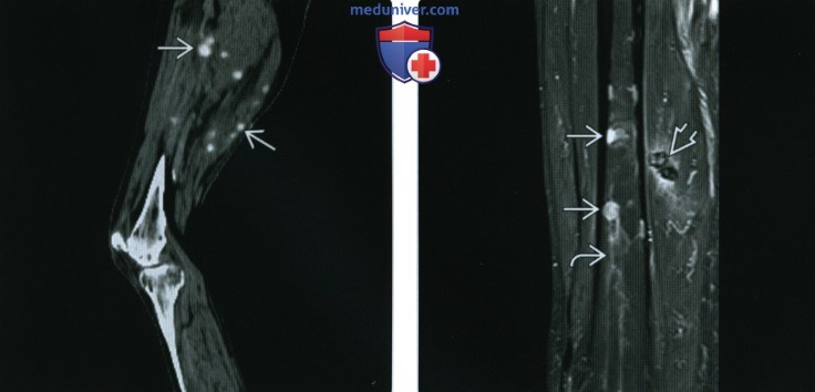 КТ, МРТ при ангиосаркоме мягких тканей