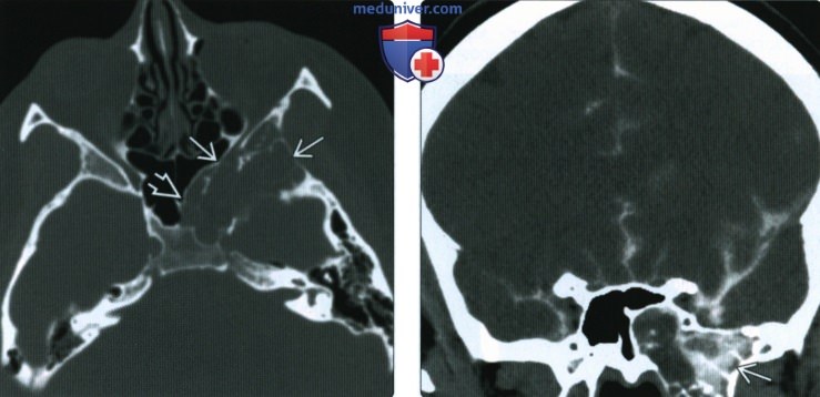 КТ, МРТ при аберрантных арахноидальных грануляциях синусов твердой мозговой оболочки