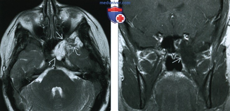 КТ, МРТ при аберрантных арахноидальных грануляциях синусов твердой мозговой оболочки