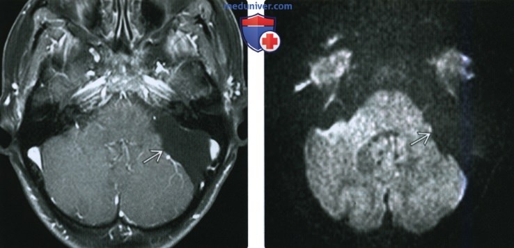 КТ, МРТ при арахноидальной кисте мостомозжечкового угла (ММУ) и внутреннего слухового канала (ВСК)