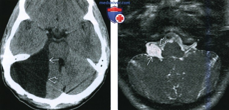 КТ, МРТ при арахноидальной кисте мостомозжечкового угла (ММУ) и внутреннего слухового канала (ВСК)