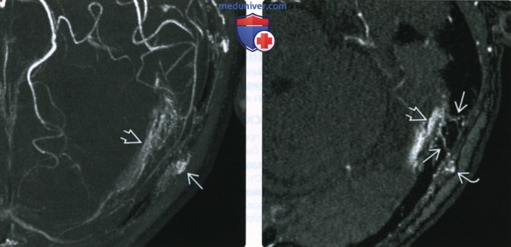 КТ, МРТ при артериовенозной фистуле твердой мозговой оболочки