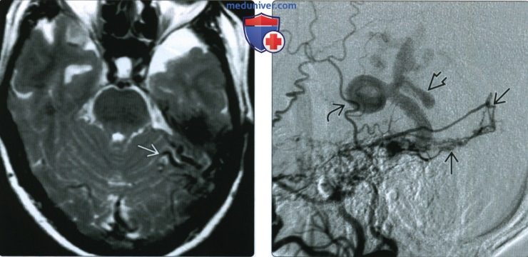 КТ, МРТ при артериовенозной фистуле твердой мозговой оболочки