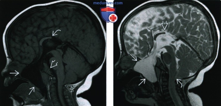 КТ, МРТ при цефалоцеле основания черепа