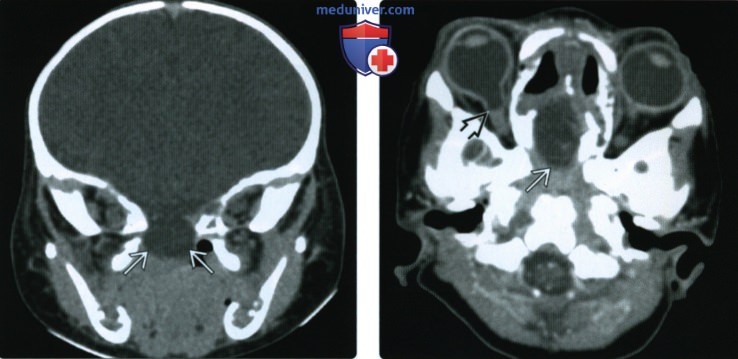 КТ, МРТ при цефалоцеле основания черепа
