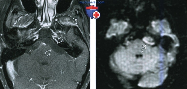 КТ, МРТ при эпидермоидной кисте мостомозжечкового угла (ММУ) и внутреннего слухового канала (ВСК)