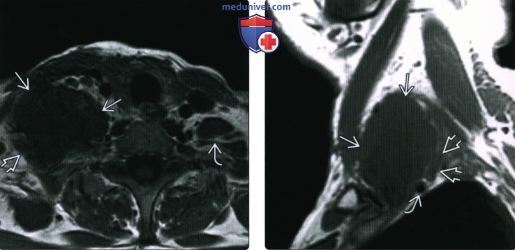 КТ, МРТ при фиброматозе головы и шеи