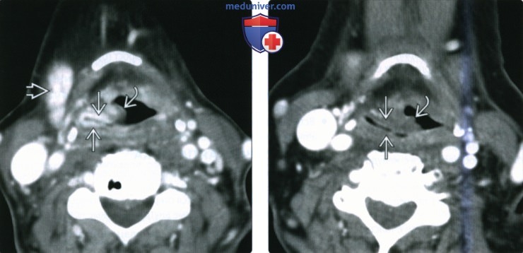 КТ, МРТ при постлучевом синдроме гортани