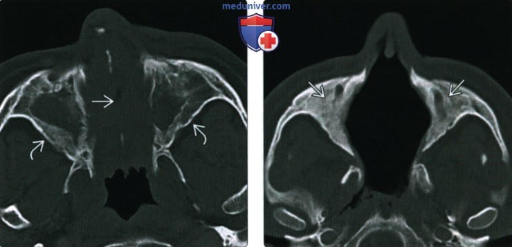 КТ, МРТ при гранулематозе с полиангиитом (Вегенера) носа, пазухи