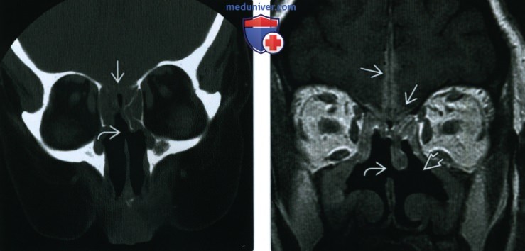 КТ, МРТ при гранулематозе с полиангиитом (Вегенера) носа, пазухи
