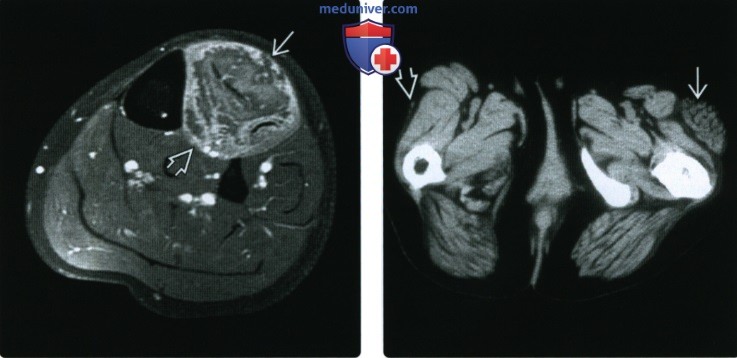 КТ, МРТ при инфекции симулирующий опухоли мягких тканей