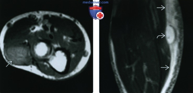 КТ, МРТ при инфекции симулирующий опухоли мягких тканей