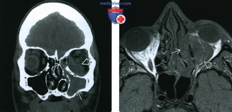 КТ, МРТ при инвазивном грибковом синусите